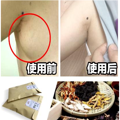 别把“副乳”挤进文胸，很危险的