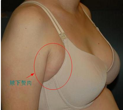 副乳到底是什么样的，要怎样穿文胸才不会长副乳