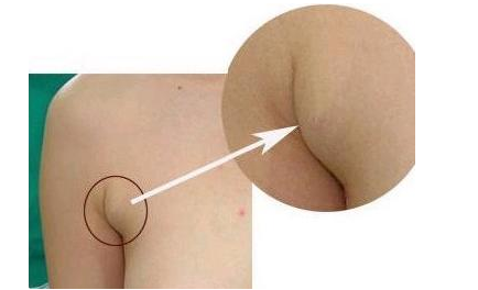 副乳到底是什么样的，要怎样穿文胸才不会长副乳