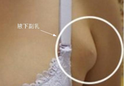 收副乳文胸真的能收住副乳吗