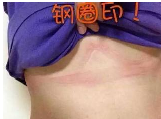解开胸罩胸部为什么有压痕