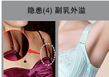 副乳是什么，穿聚拢文胸收副乳吗